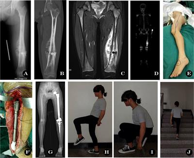 Preserving the rectus femoris and improving limb function after total femoral prosthesis replacement following resection of femoral malignant tumors
